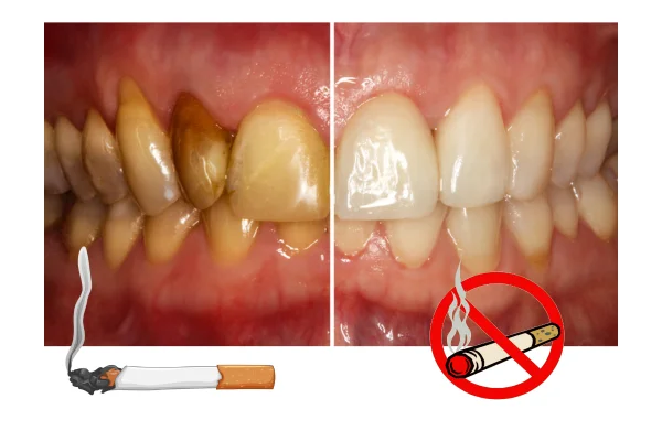 teeth before and after quilt smoking