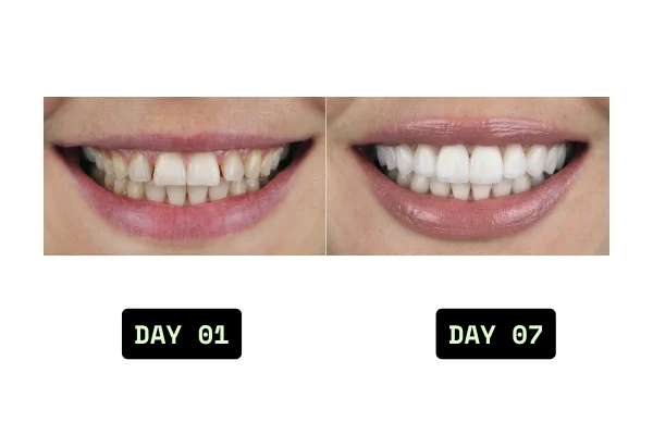 smile comparison
